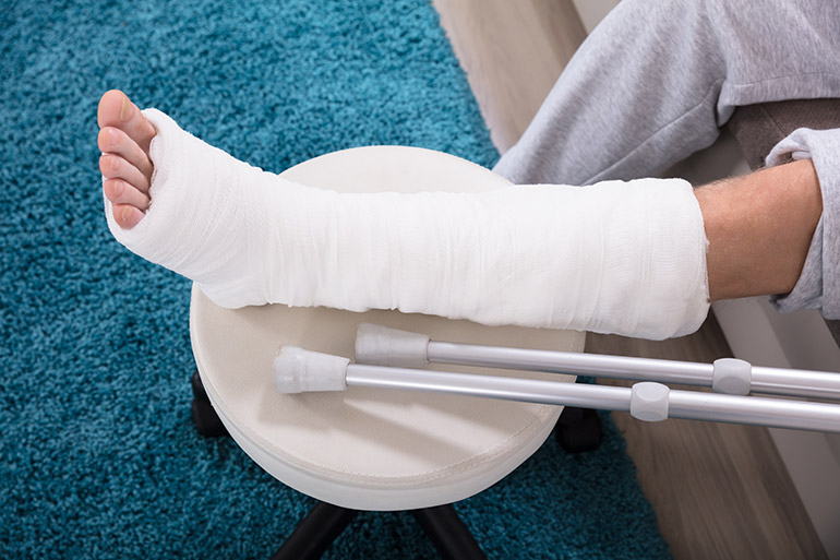 mann zeigt ein gebrochenes bein im gips